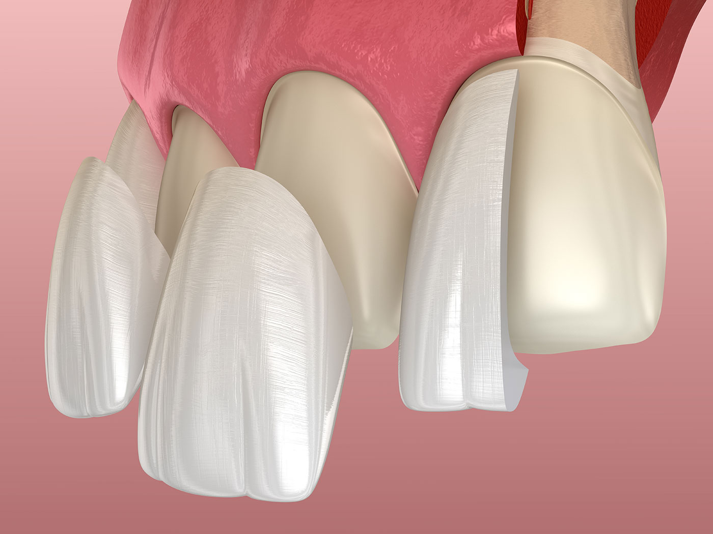 Dental Veneers