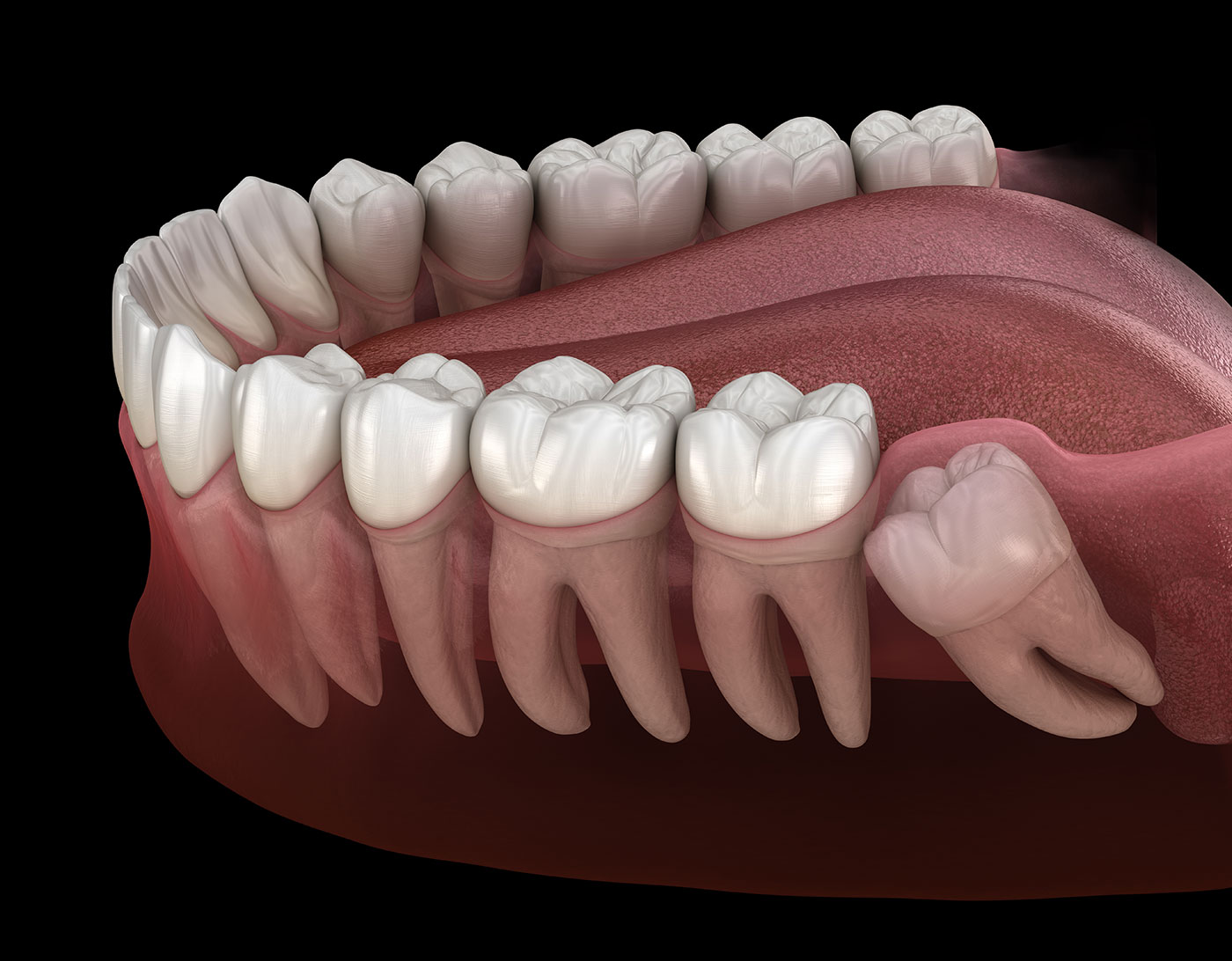 Wisdom teeth extraction photo