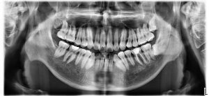 Wisdom Tooth (Before)
