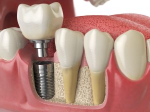 dental bone grafting