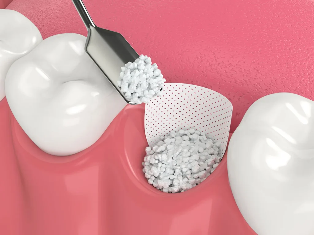 Bone Grafting In Scarborough