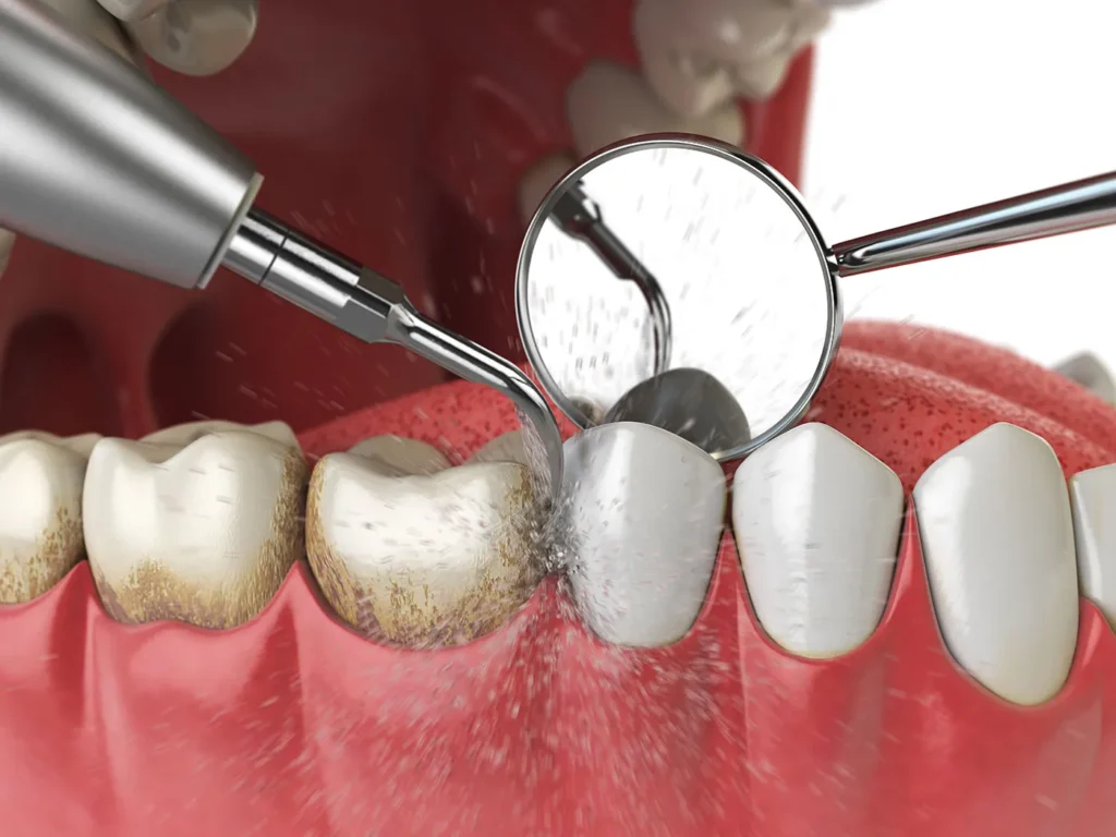 Dental Cleaning