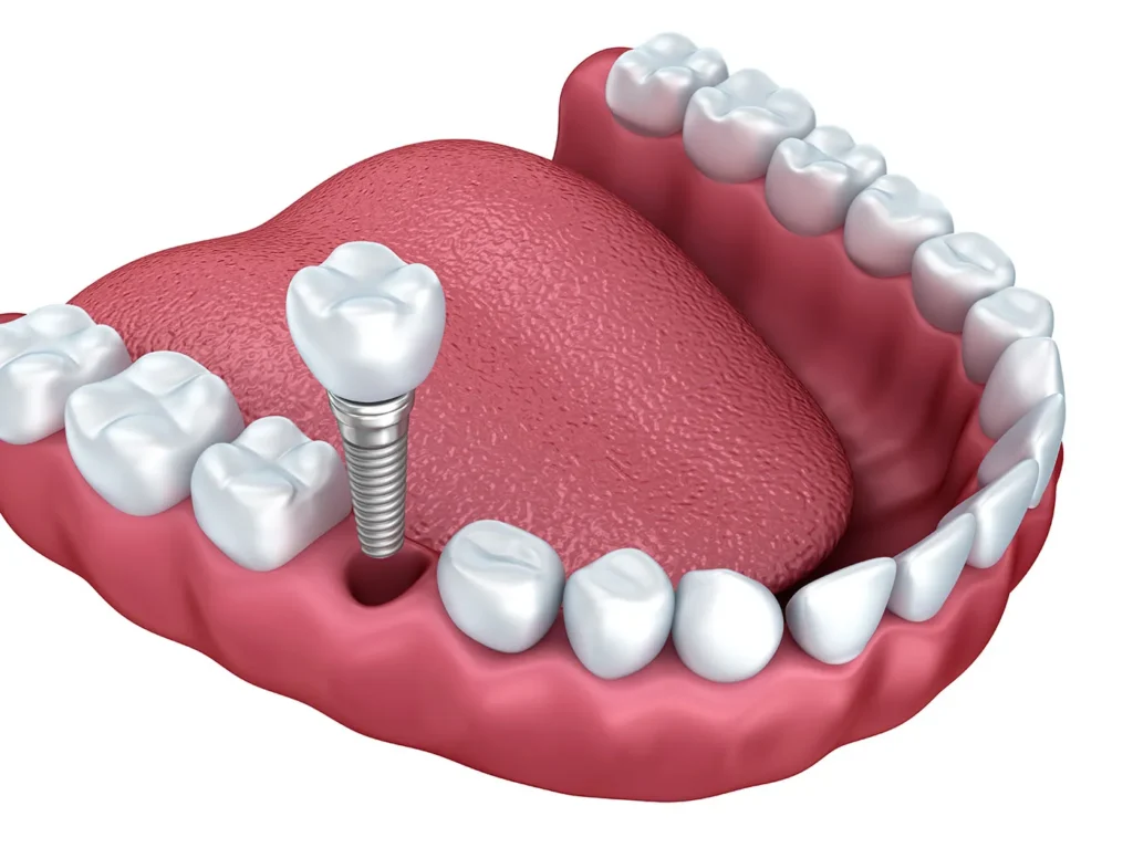 Dental Implants Scarborough