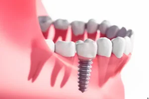 dental implants