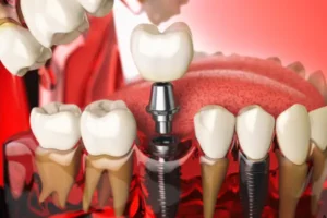 Dental implants