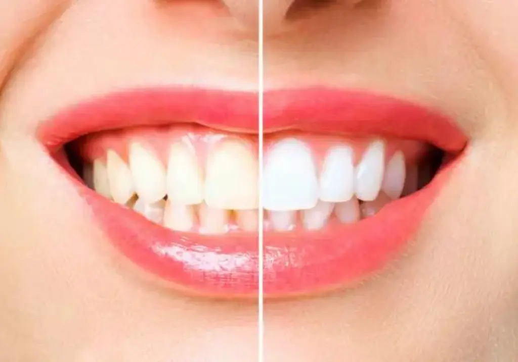TEETH WHITENING in Scarborough
