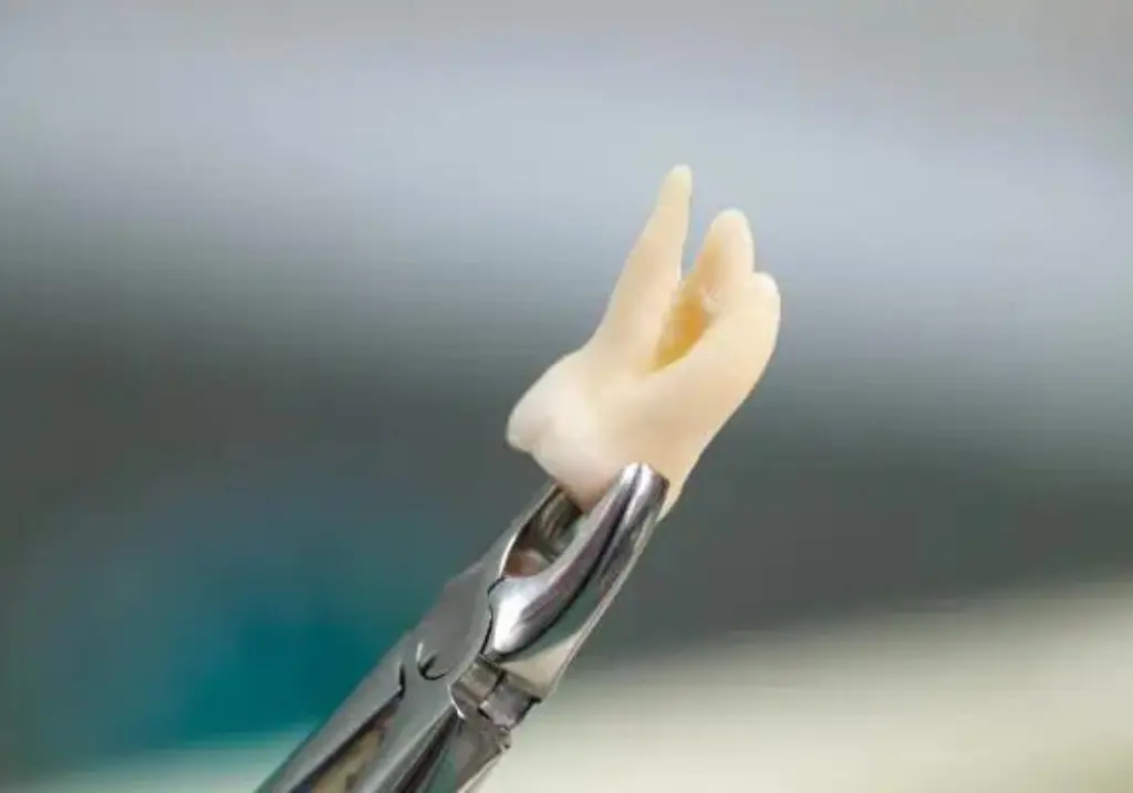 Teeth Extraction in Scarborough