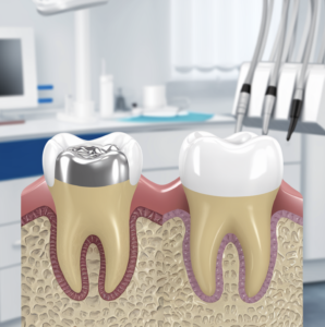 Amalgam vs. White Fillings