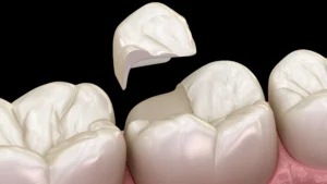 How to Heal Cracked Teeth Naturally