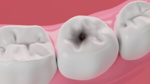 Recognizing and Treating Tooth Decay Under Dental Crowns
