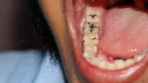 Types of Cavities: Understanding the Different Forms of Tooth Decay