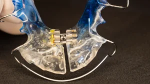 Types of Removable Orthodontic Appliances