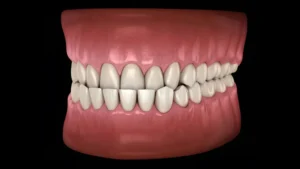 Underbite Treatment Is Surgery Really Important