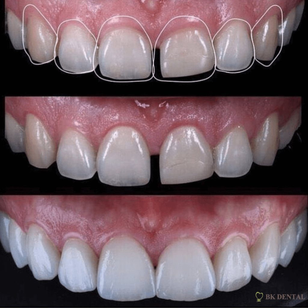Veneer before and after. showing how to prevent gaps between teeth