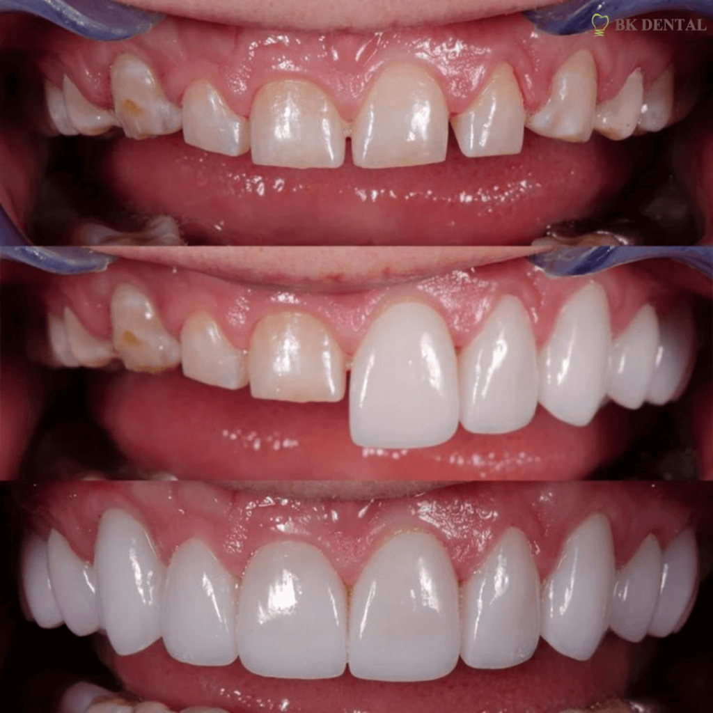 Veneer before and after