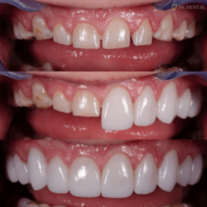 Veneer before and after